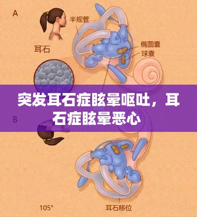 突發(fā)耳石癥眩暈嘔吐，耳石癥眩暈惡心 