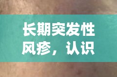 長期突發(fā)性風(fēng)疹，認(rèn)識、預(yù)防與治療全攻略